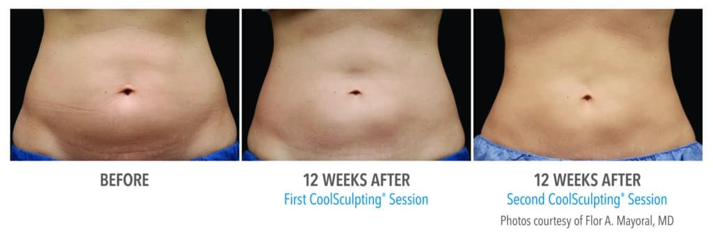 CoolSculpting Abdomen