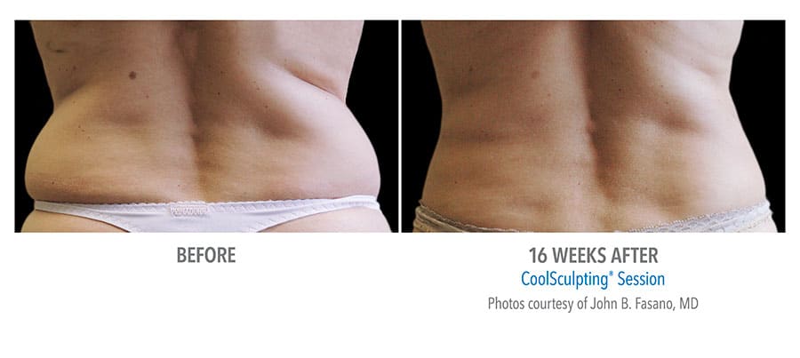 CoolSculpting flanks before after