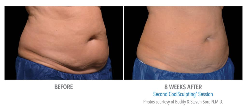 coolsculpting near me