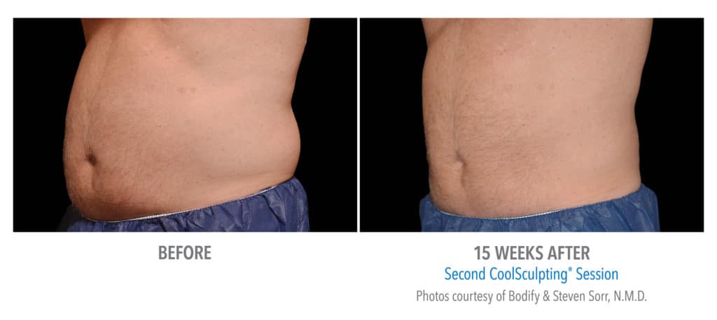 Coolsculpting - Refine Aesthetics