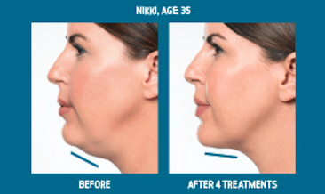 refine-aesthetics-kybella-female-2