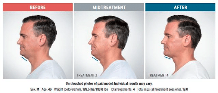 refine-aesthetics-kybella-male