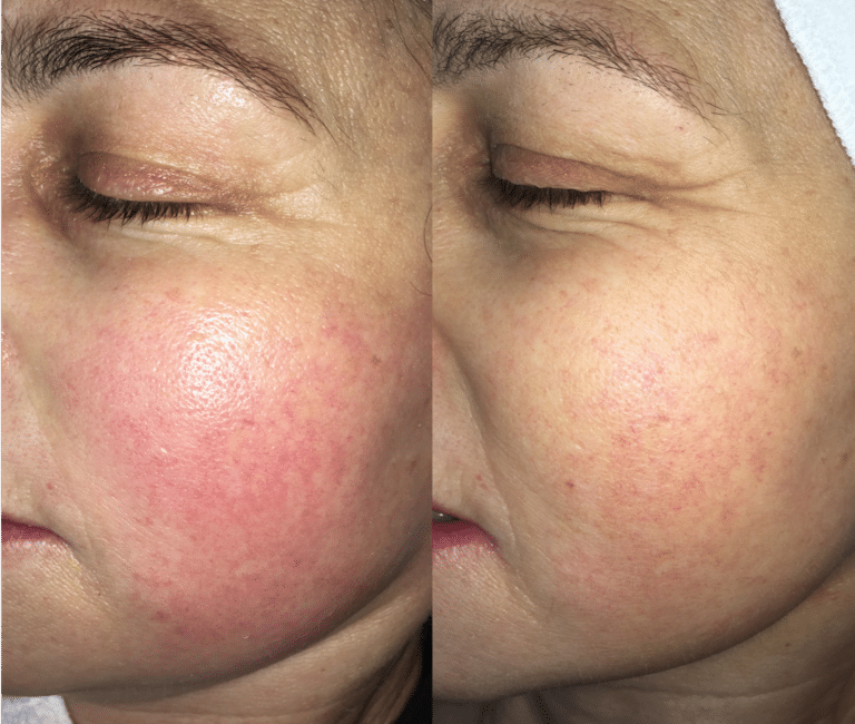 016ProcellRosacea