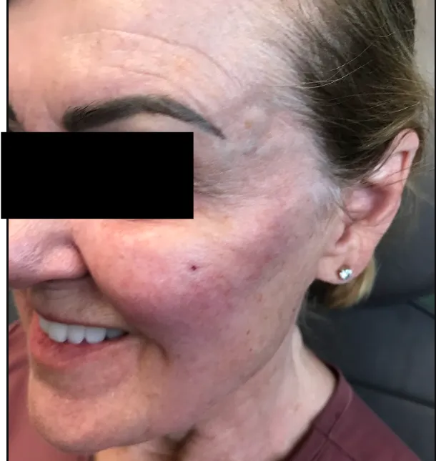 Close-up of a patient's face after a personalized treatment at a Colorado Springs medical aesthetics clinic.