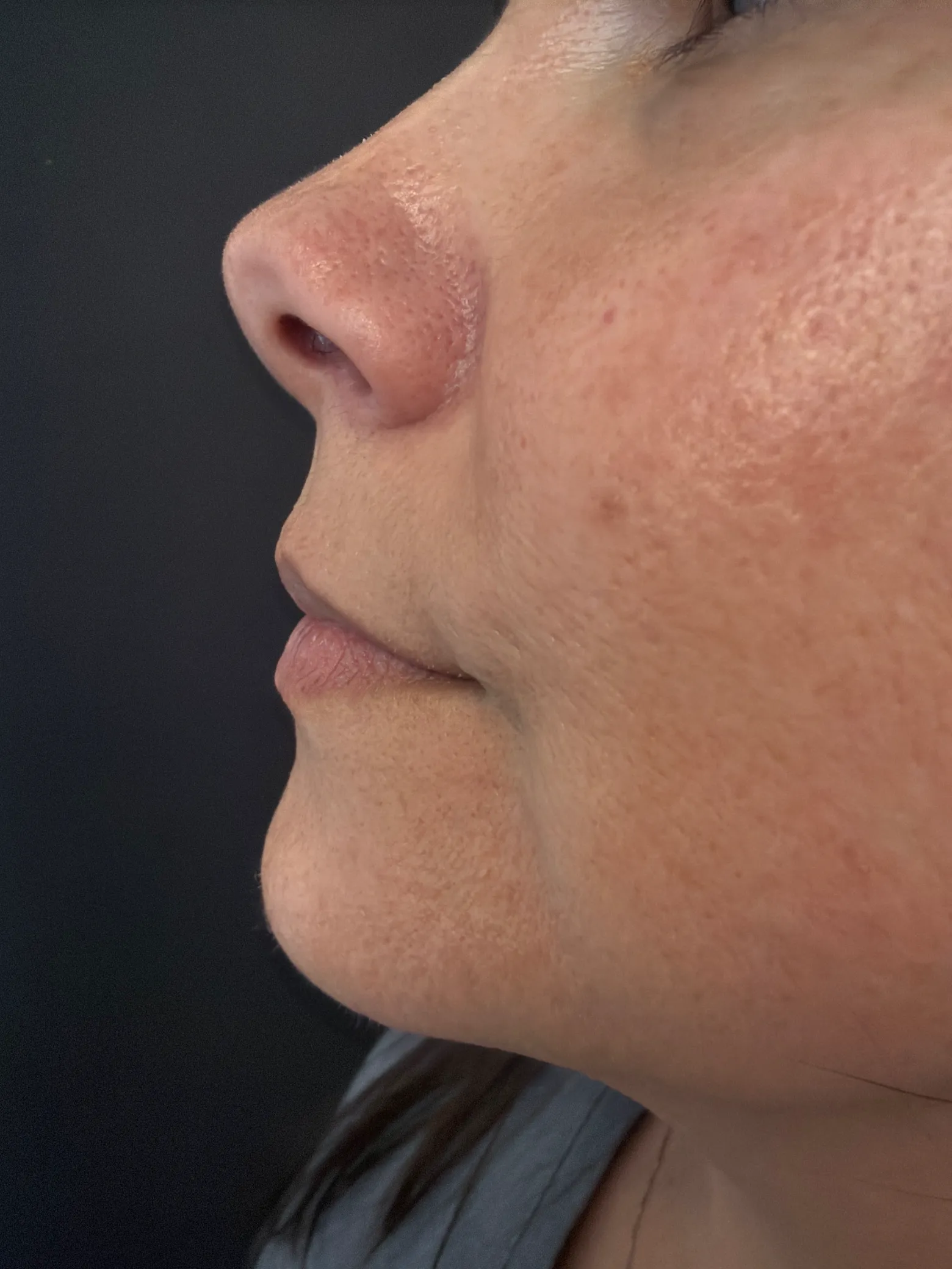 Close-up of a person's cheek and nose showing skin texture, possibly before a treatment at a Colorado Springs medical aesthe…