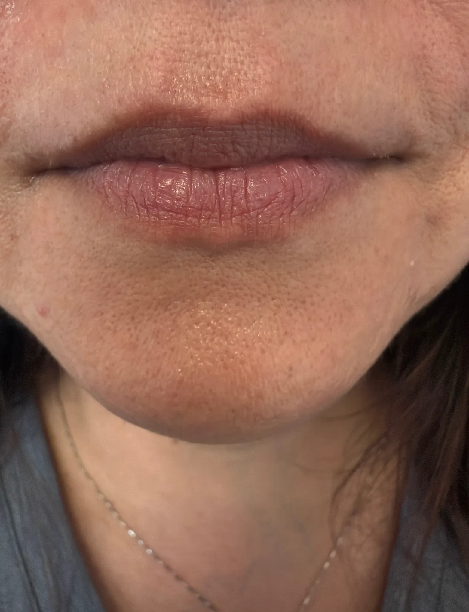 Close-up of a person's lips before a personalized treatment at a Colorado Springs medical aesthetics clinic.