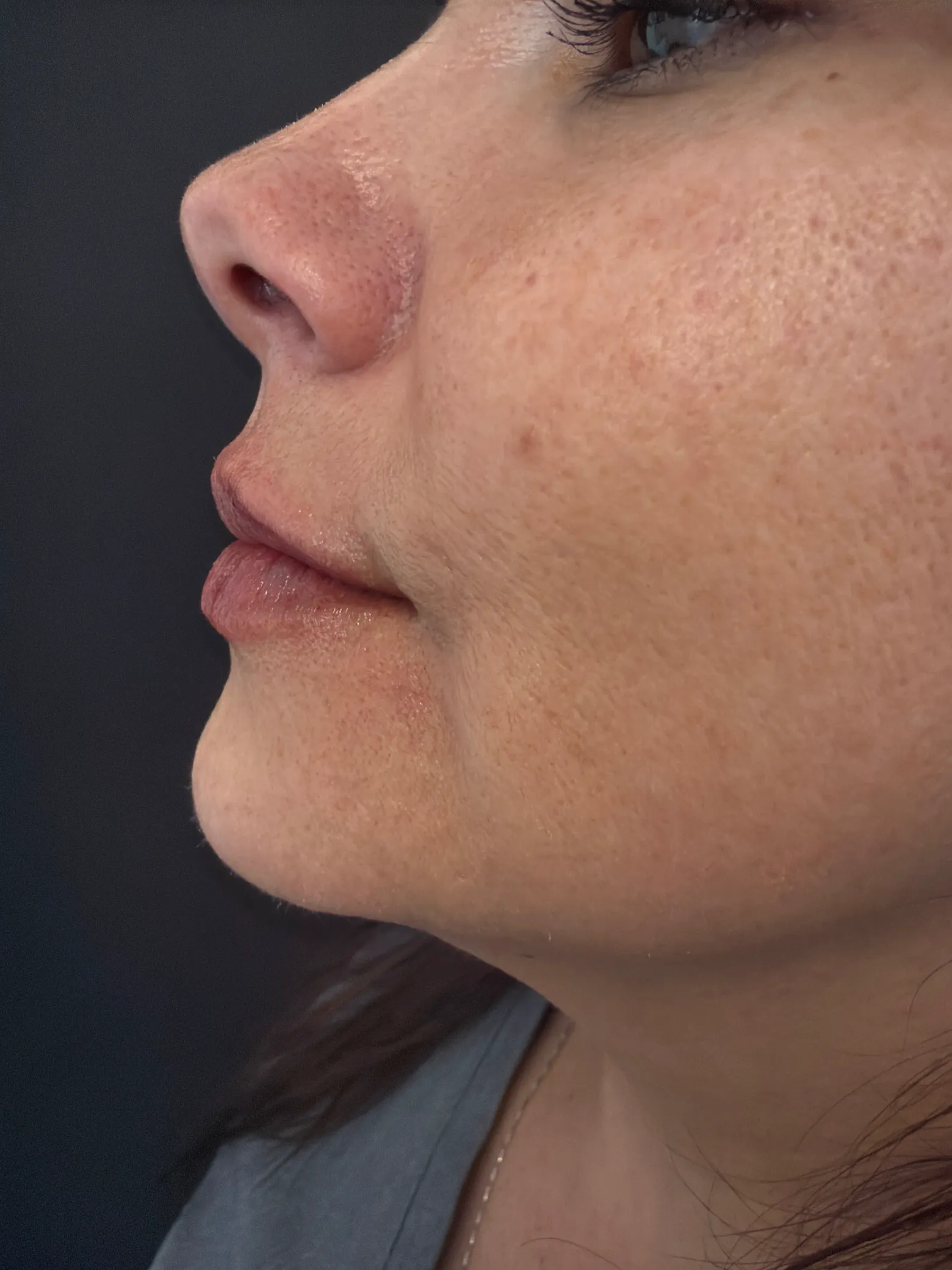 Side profile of a woman's face with healthy skin texture, highlighting services from a Colorado Springs medical aesthetics c…