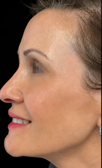 Side profile of a woman with smooth skin, highlighting Refine Aesthetics' personalized treatment results in Colorado Springs.
