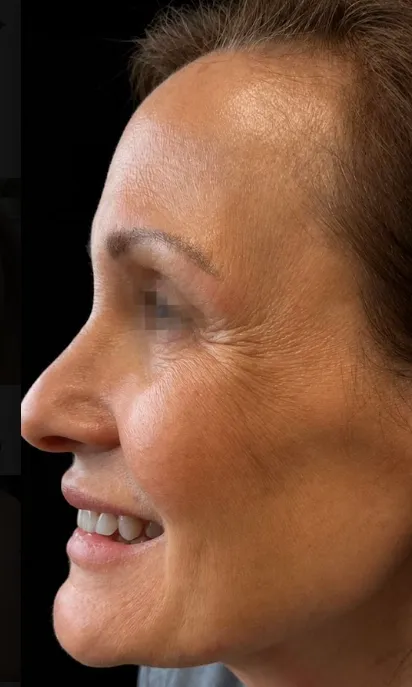 Woman smiling with smooth skin after a treatment at a Colorado Springs medical aesthetics clinic.